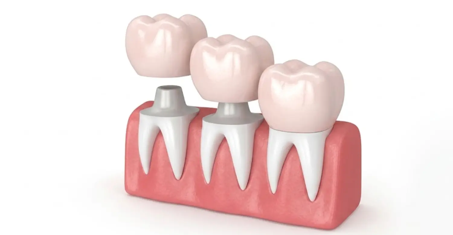 Zirconia Crowns Cost 2
